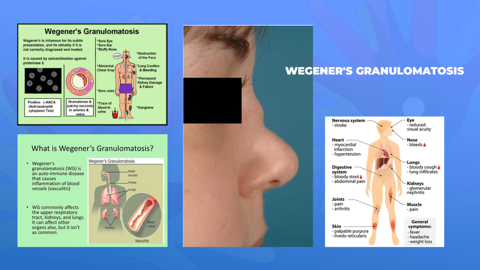 Ги запознаваме ретките болести: Вегенерова грануломатоза (ВИДЕО)