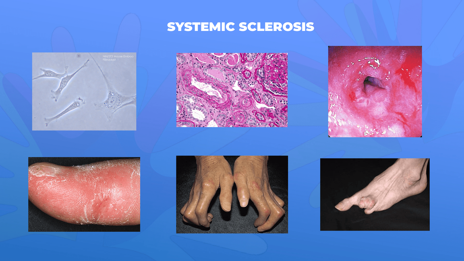 Ги запознаваме ретките болести: Склеродермија (Системска склероза) – Systemic sclerosis