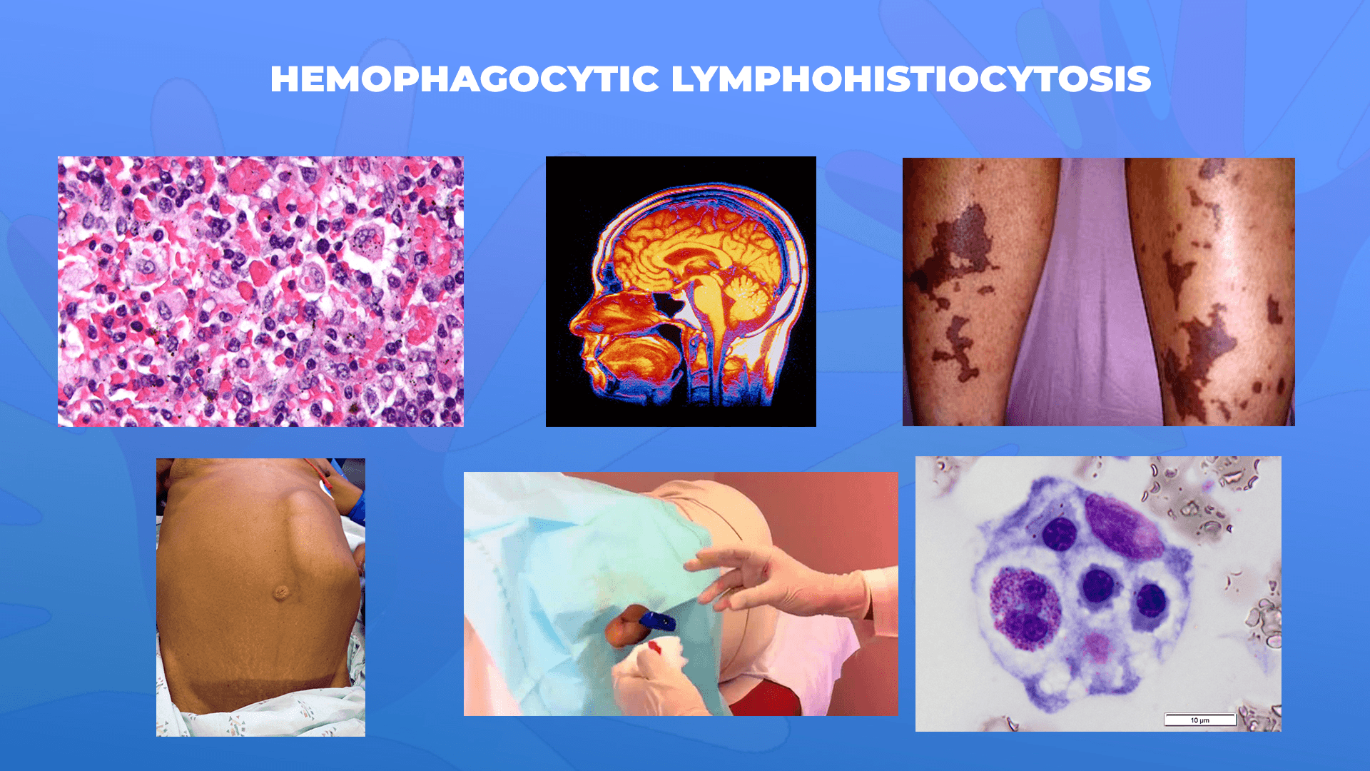 Ги запознаваме ретките болести: Хемофагоцитната лимфохистиоцитоза – Hemophagocytic lymphohistiocytosis
