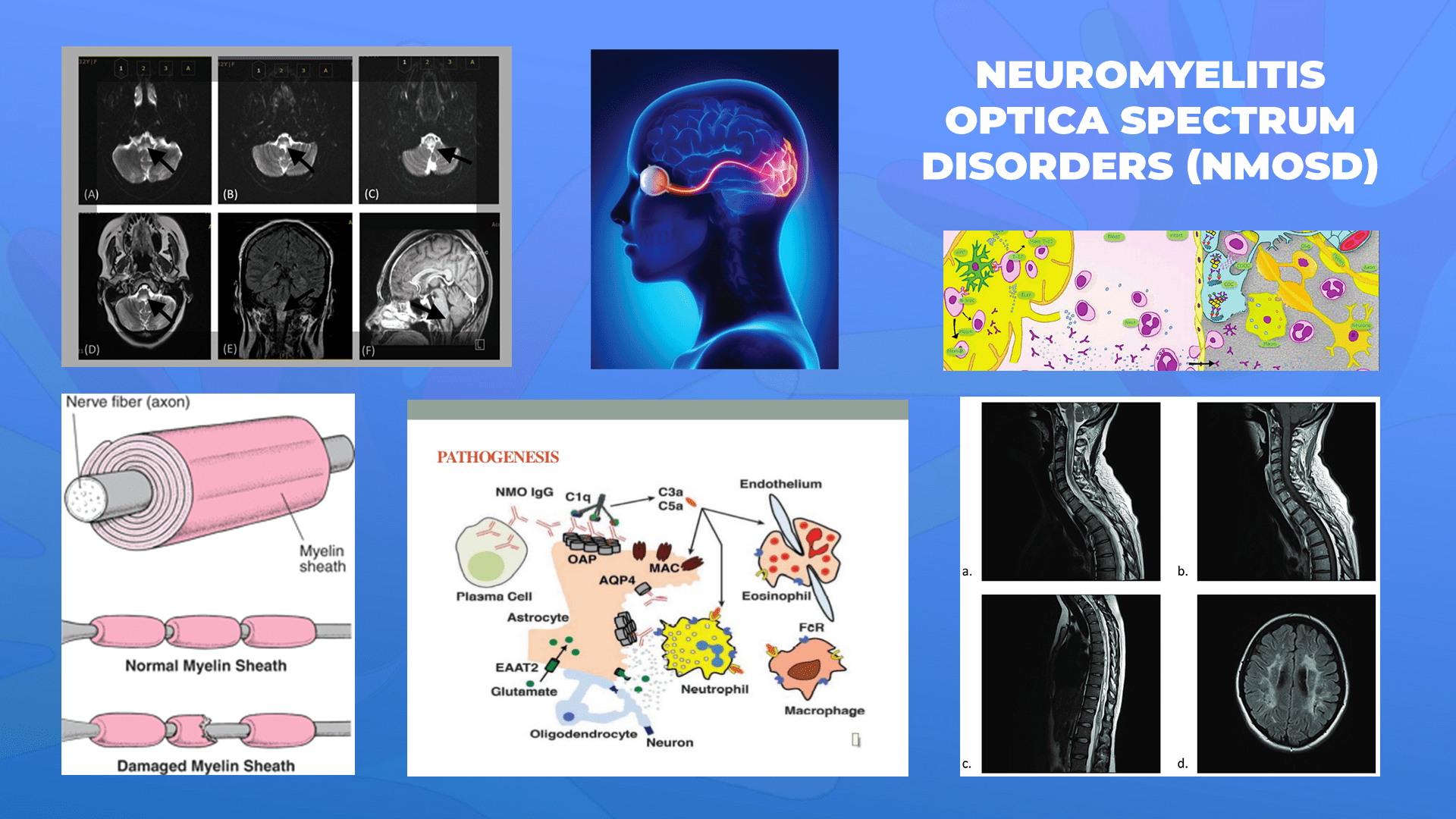 Ги запознаваме ретките болести: Неуромиелитис оптика спектар на нарушувања – (NMOSD – neuromielitis optica spectrum of disorders)
