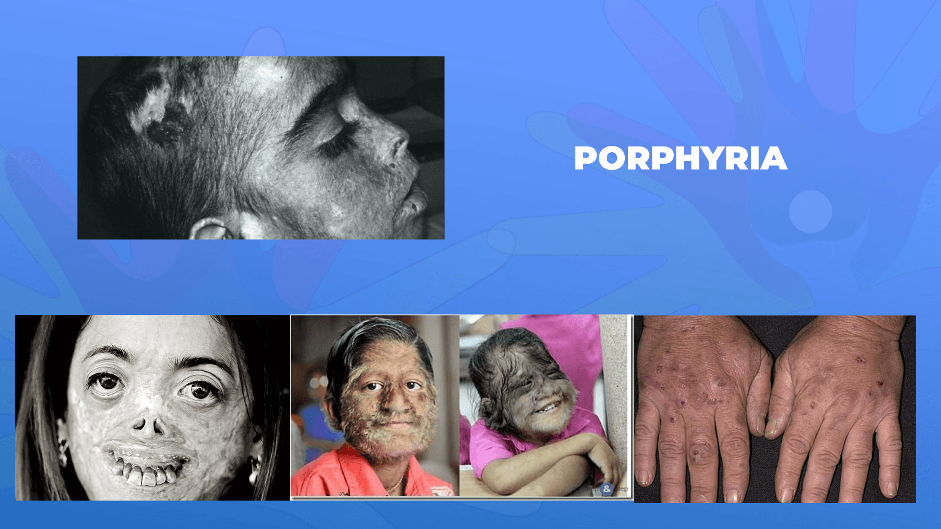 Ги запознаваме ретките болести: Порфирија