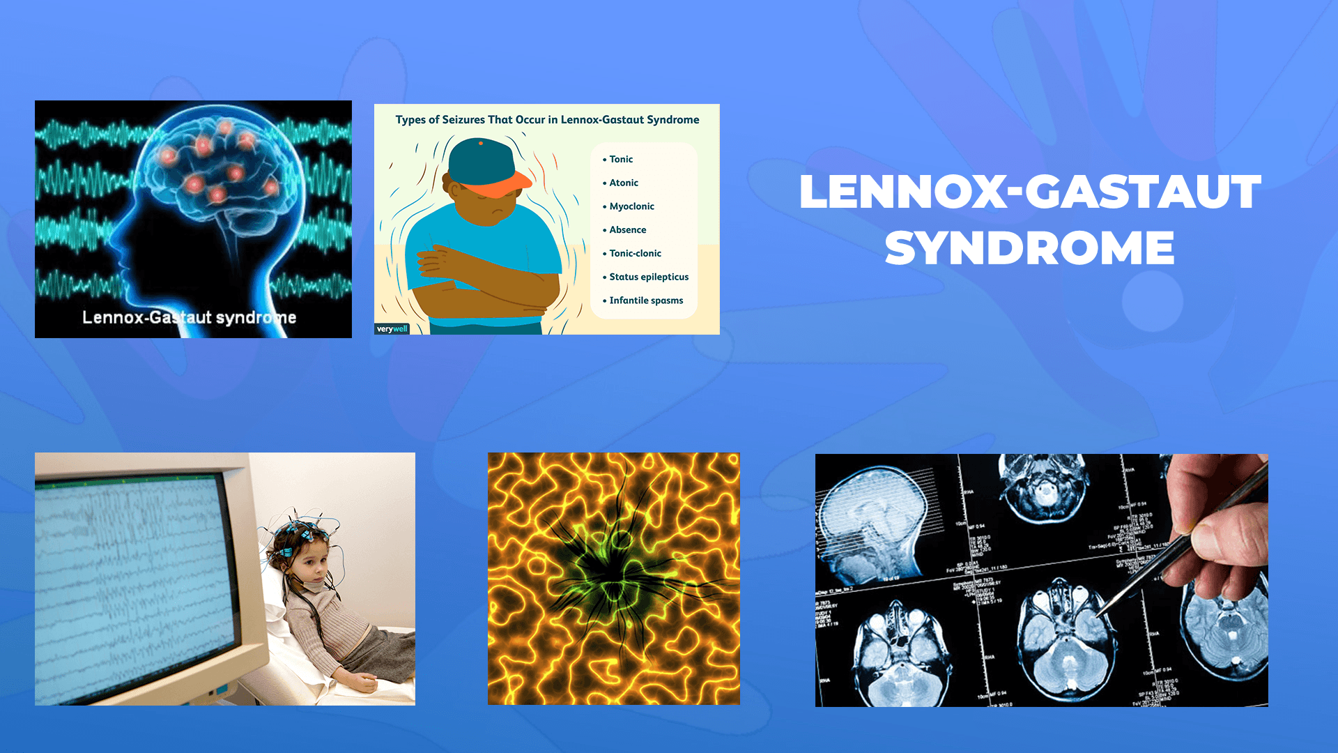 Ги запознаваме ретките болести: Синдром на Lennox-Gastaut 