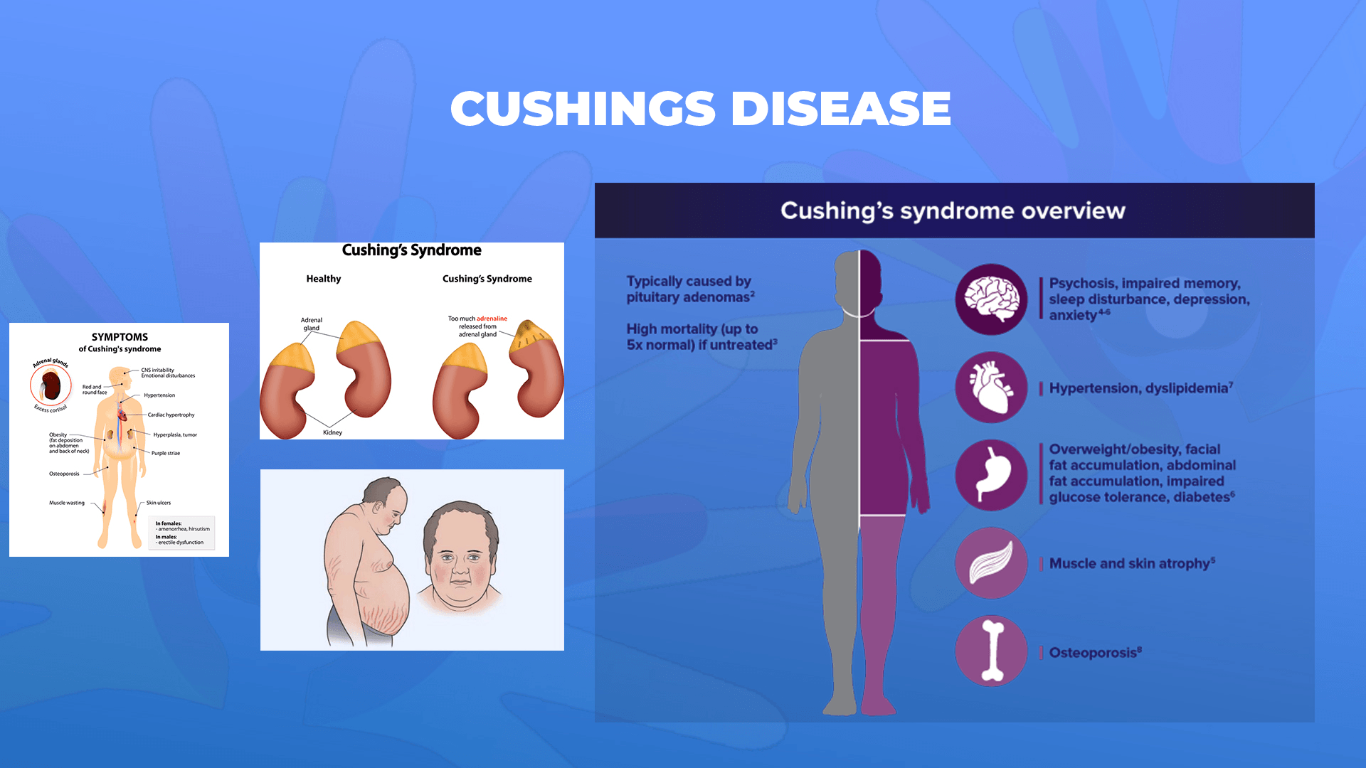 Ги запознаваме ретките болести: Болест на Кушинг