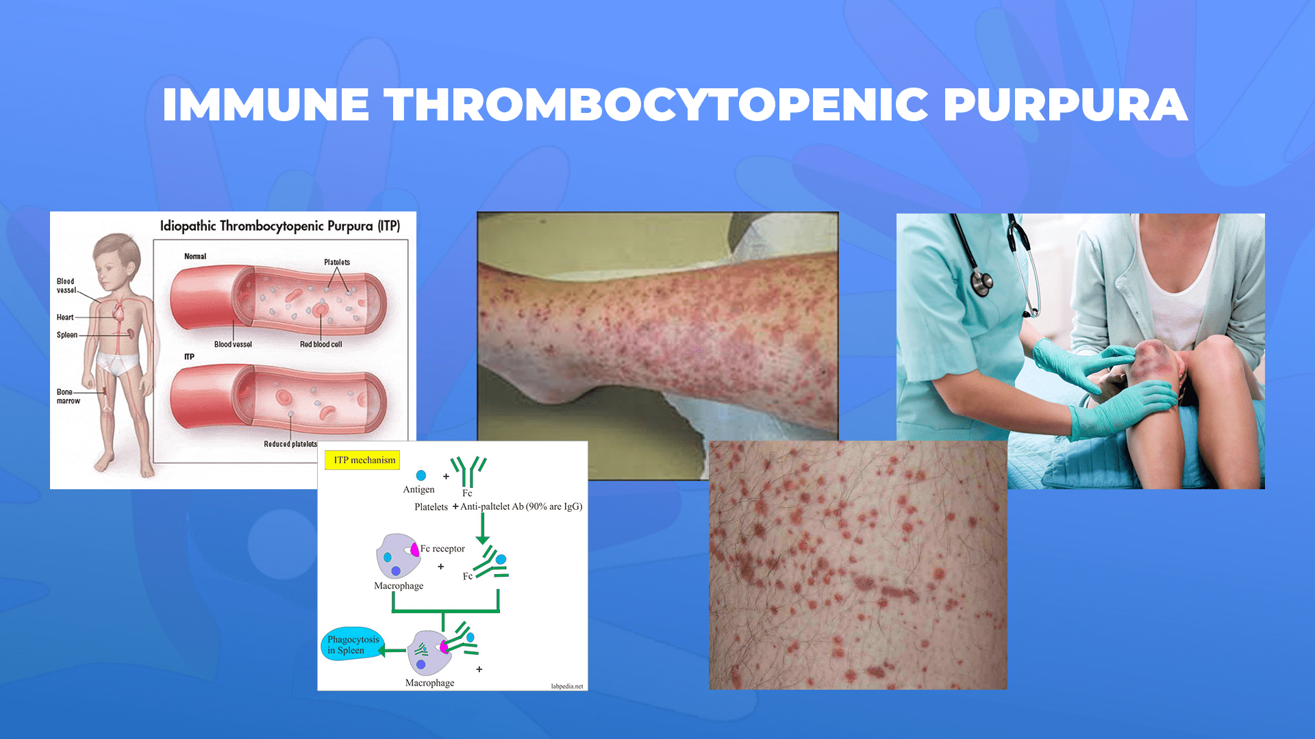 Ги запознаваме ретките болести: Идиопатска тромбоцитопенична пурпура-Immune thrombocytopenic purpura