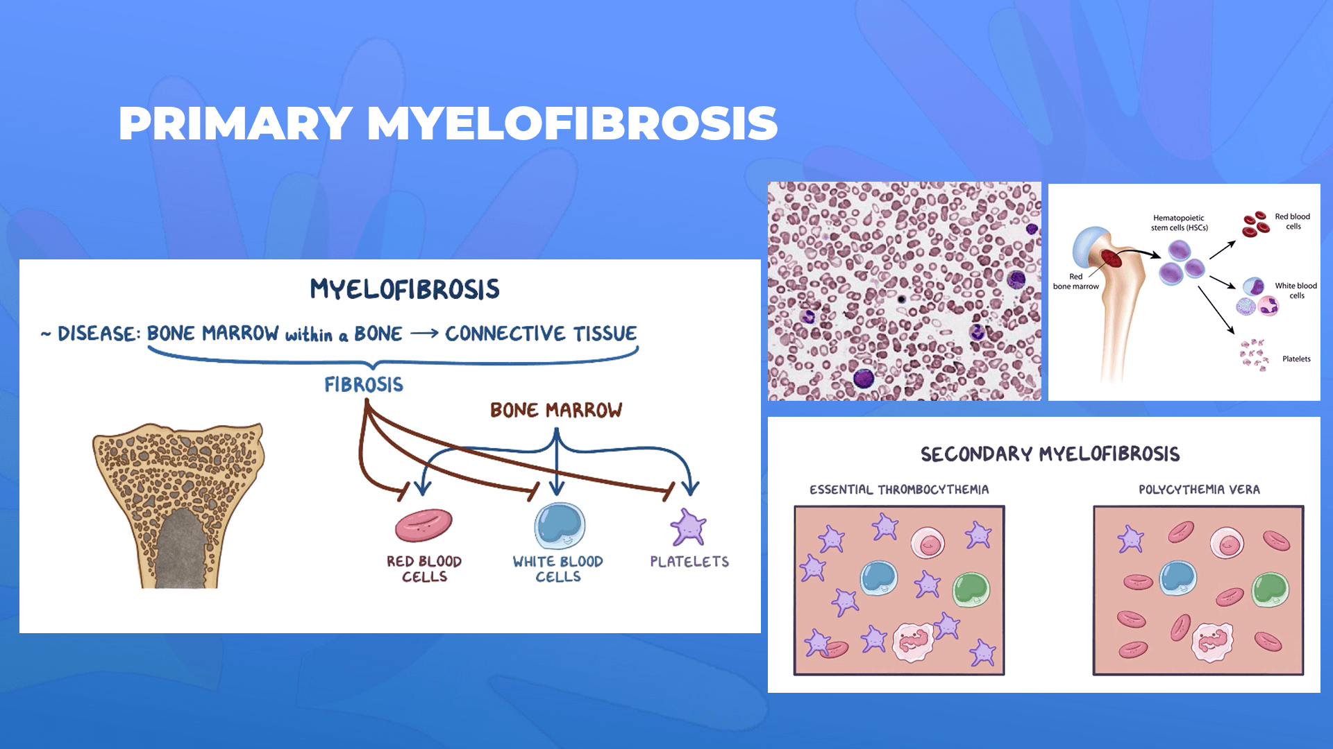 Ги запознаваме ретките болести: Примарна миелофиброза – Primary myelofibrosis