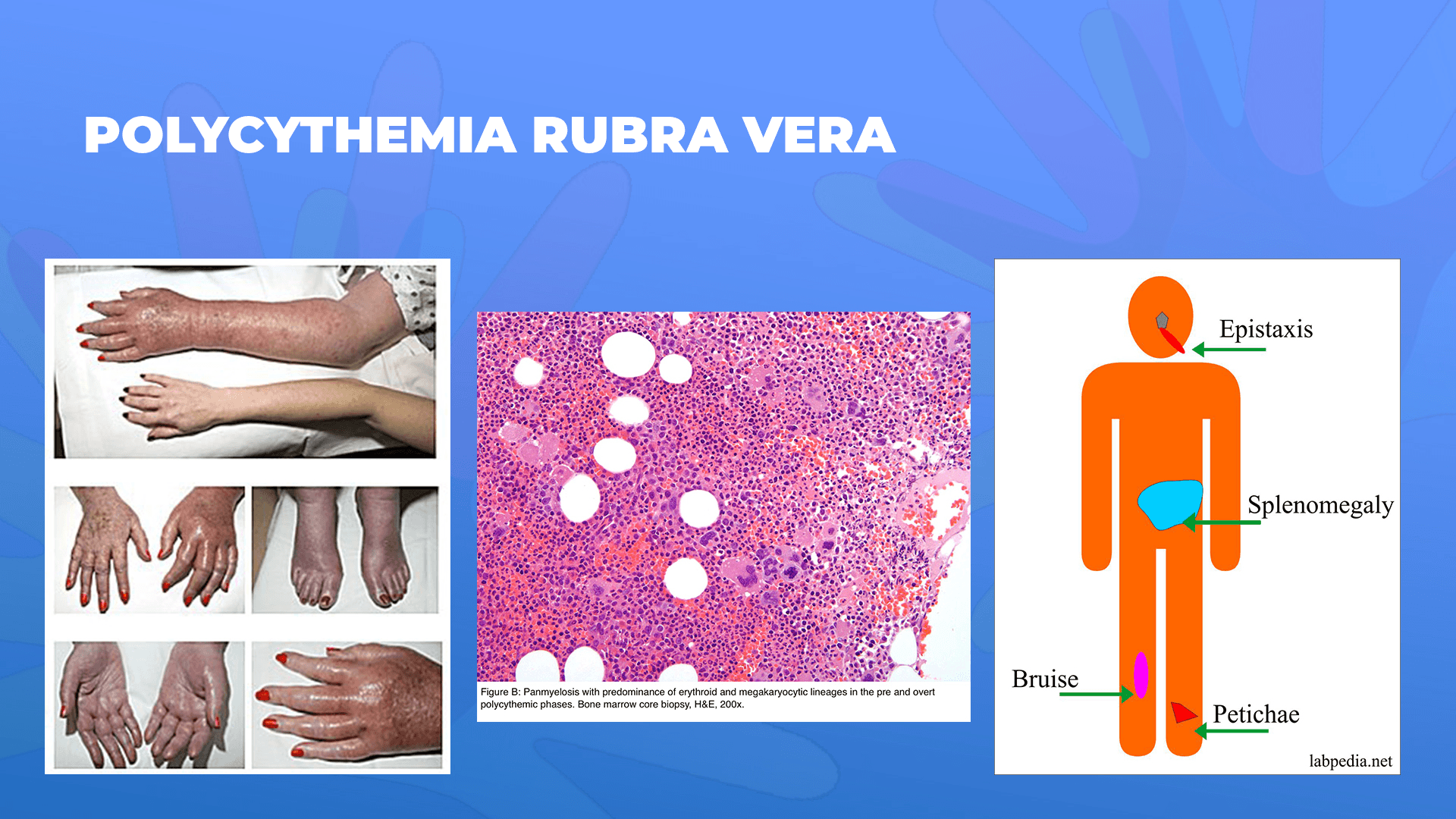 Ги запознаваме ретките болести: Полицитемија Рубра Вера – Polycythemia Rubra Vera