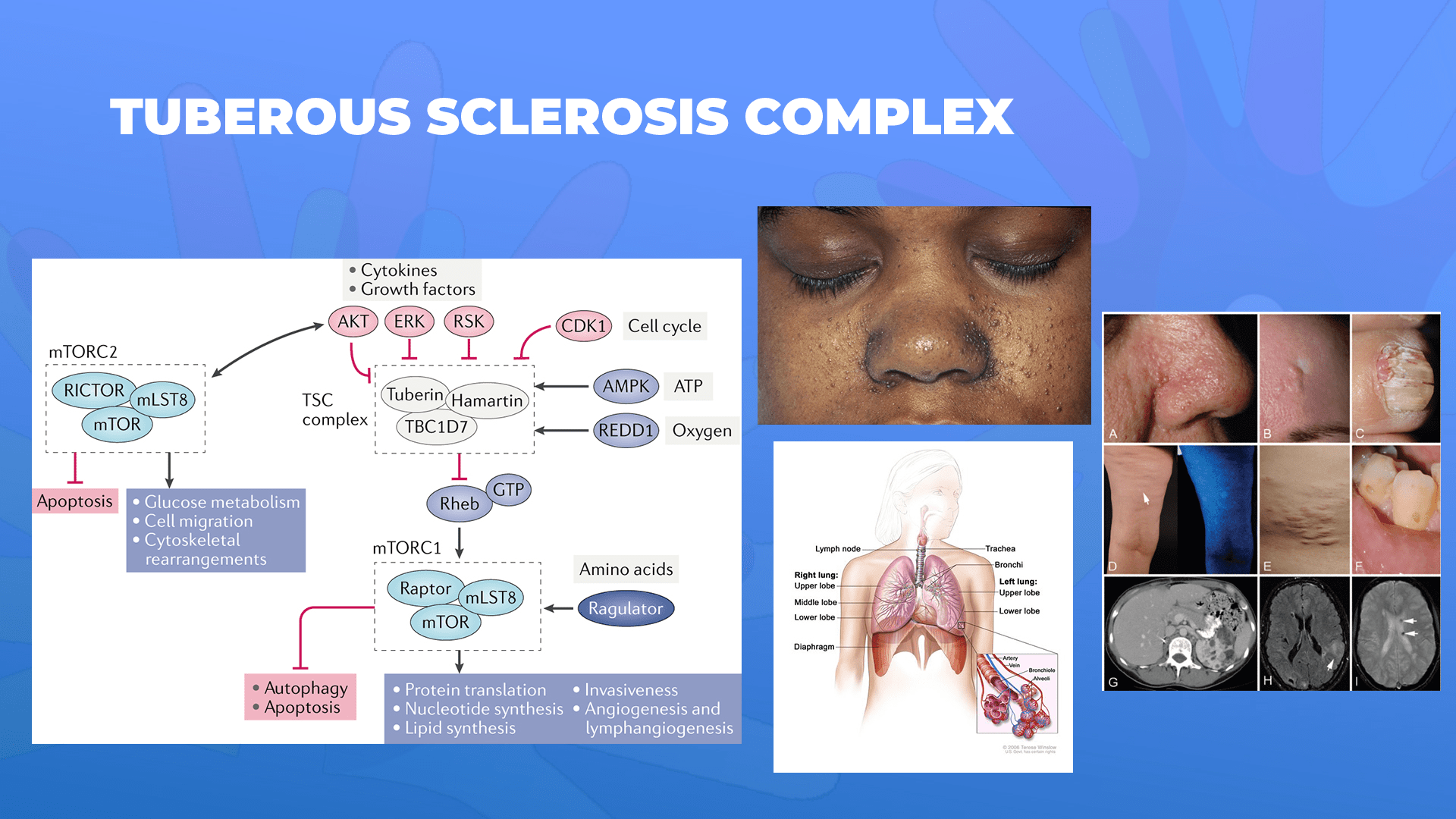 Ги запознаваме ретките болести: Туберозна склероза комплекс – Tuberous sclerosis complex
