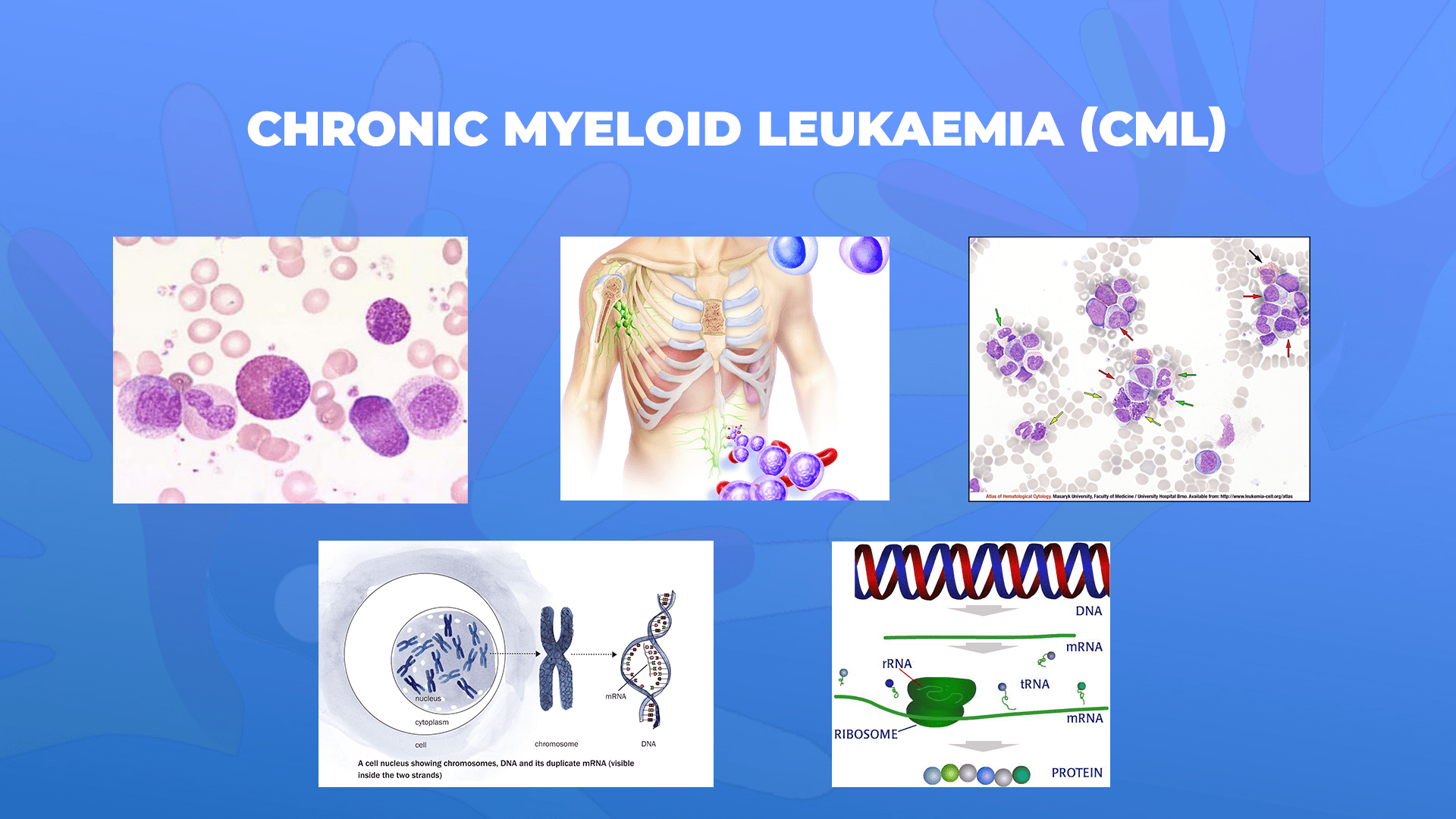 Ги запознаваме ретките болести: Хронична миелоидна леукемија-Chronic myeloid leukaemia (CML)