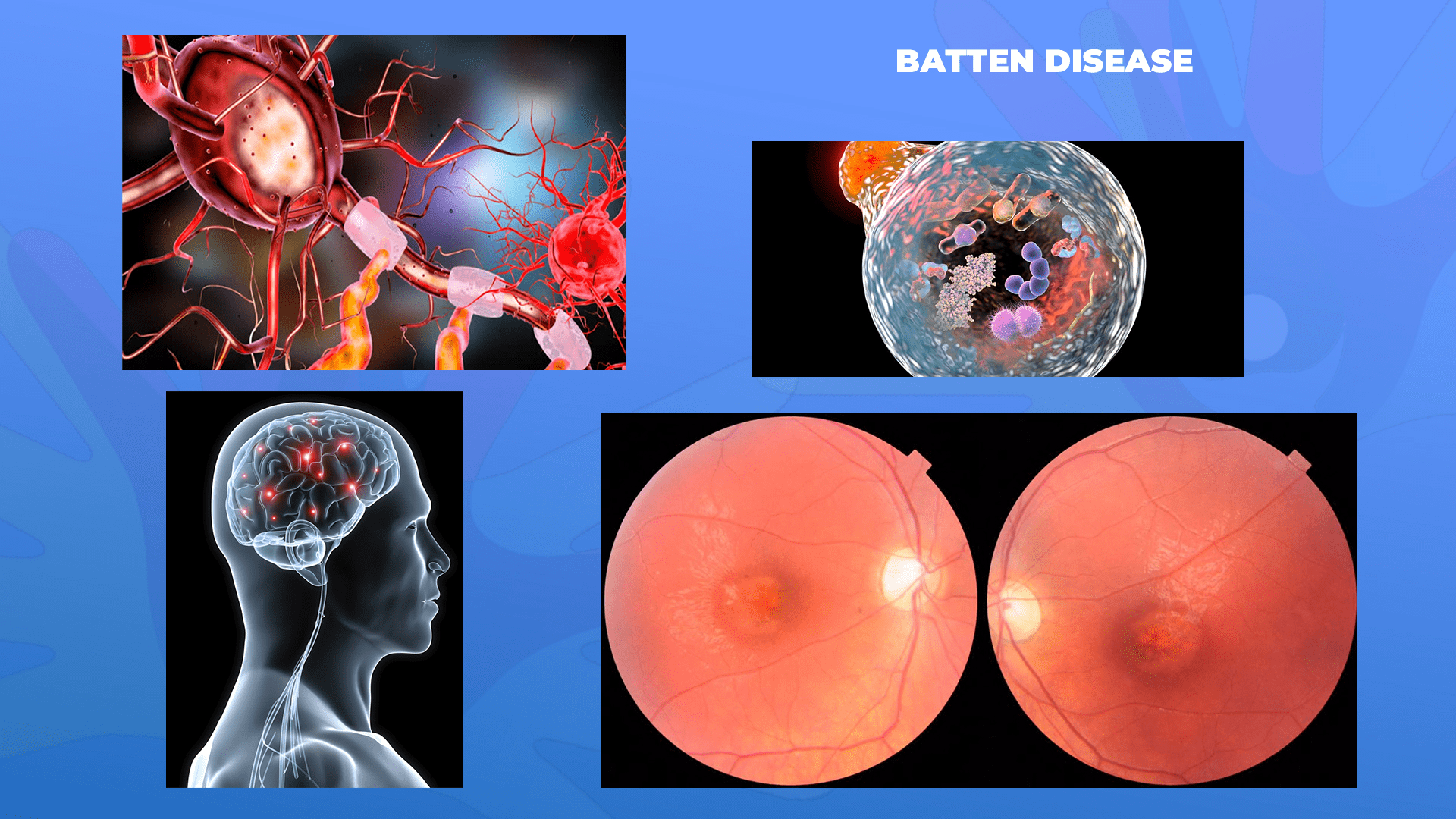 Ги запознаваме ретките болести: Батенова болест – Batten disease