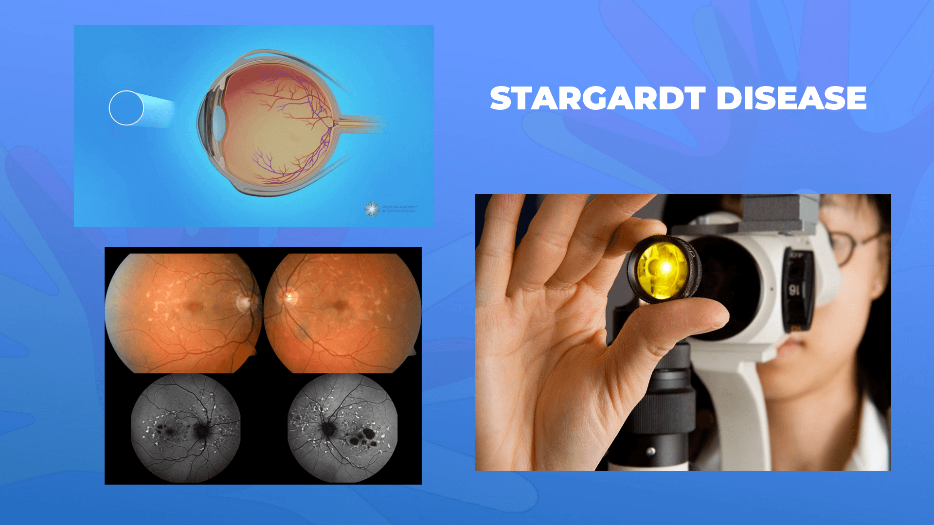 Ги запознаваме ретките болести: Старгардова болест – Stargardt disease