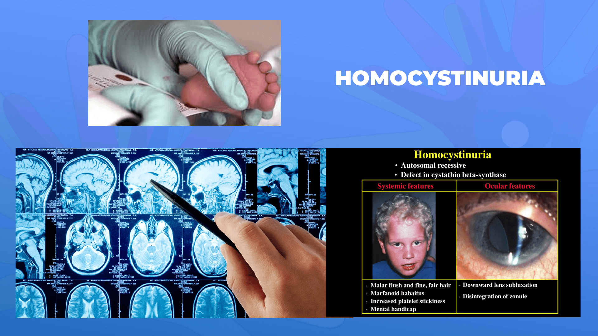Ги запознаваме ретките болести: Хомоцистинурија – Homocystinuria