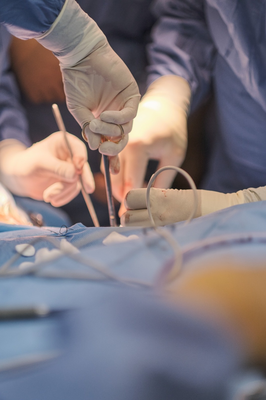 Во тек е трансплантација на бубрег од починат донор, експлантирани се коскени ткива