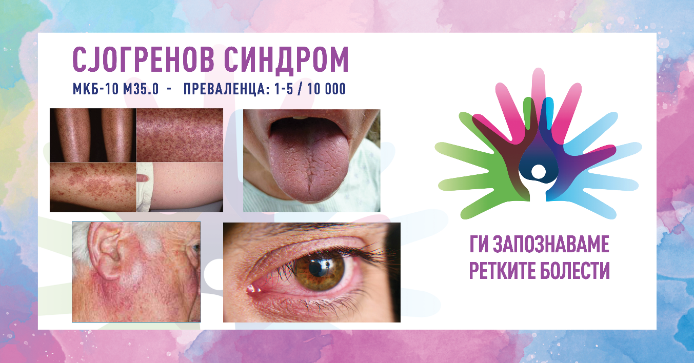 Ретки болести 2026: Сјогренов синдром